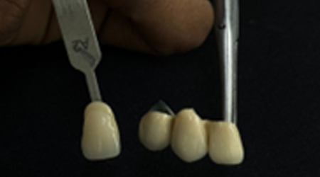 PFM-vinayaga dental lab