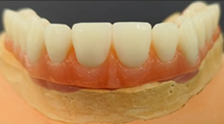 vinayaga dental lab Hybrid Bar Denture-vinayaga dental lab