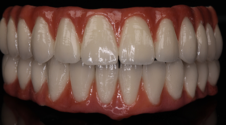 vinayaga dental lab Implant Cement Retainer-vinayaga dental lab