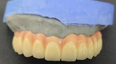 Implant DMLS