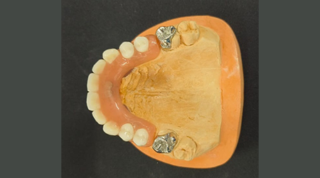 vinayaga dental lab Implant Attachment Dentures-vinayaga dental lab