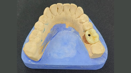vinayaga dental lab Implant screw retainer zirconium-vinayaga dental lab