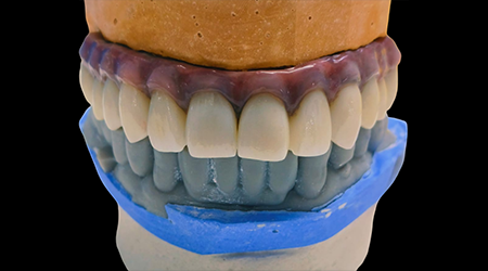 vinayaga dental lab Palomolo Trimming-vinayaga dental lab