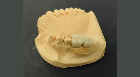 vinayaga dental lab Precision Attachment-vinayaga dental lab